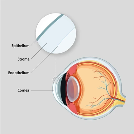 What is Corneal Cross Linking