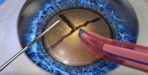 Cataract surgery before laser assisted