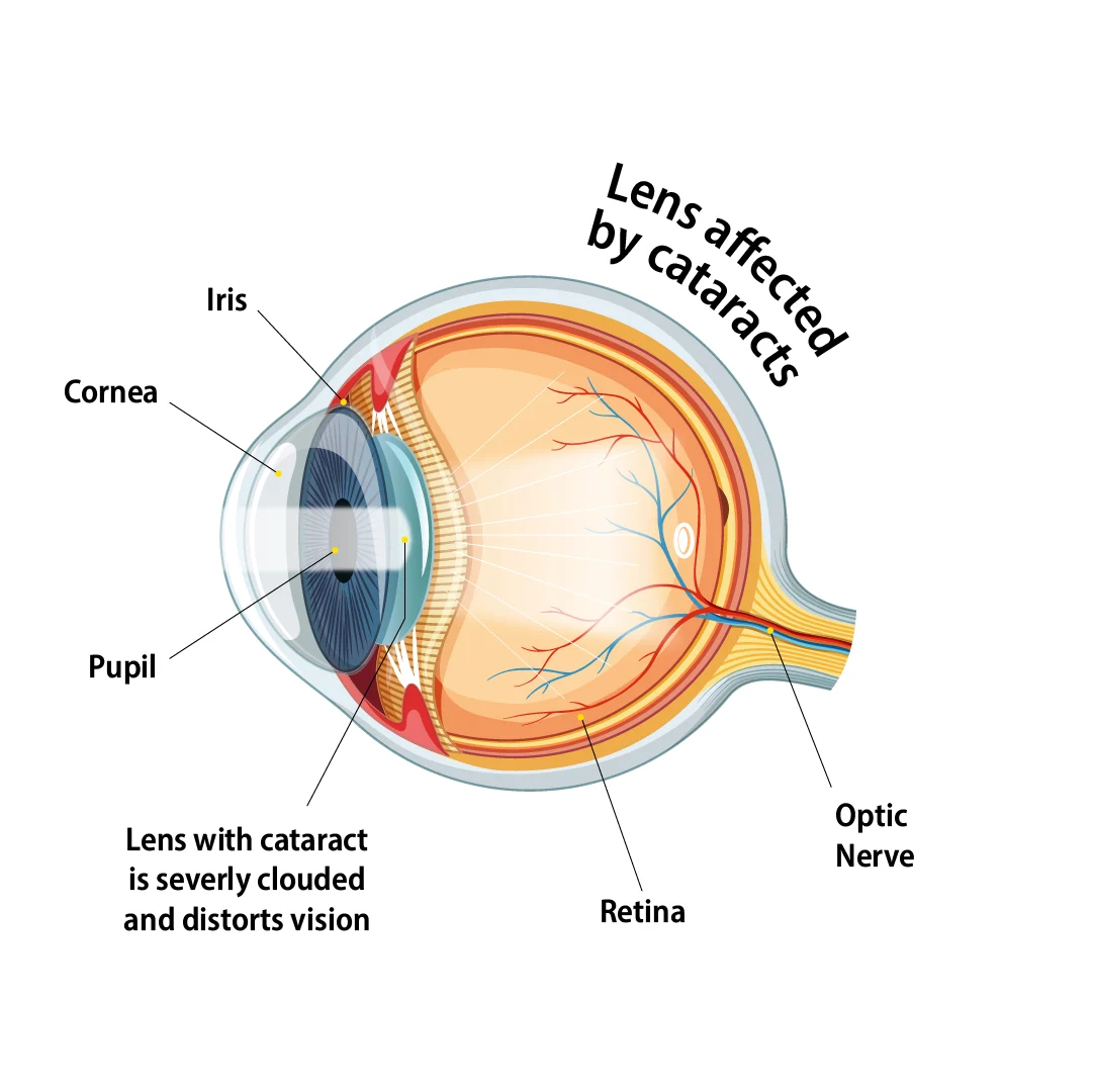 Lens affected by cataracts