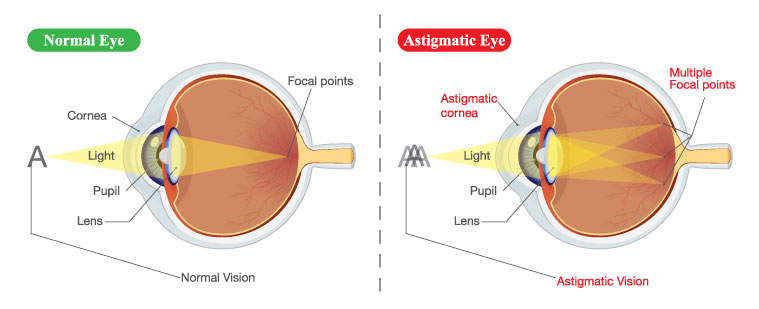 astigmatism diagram