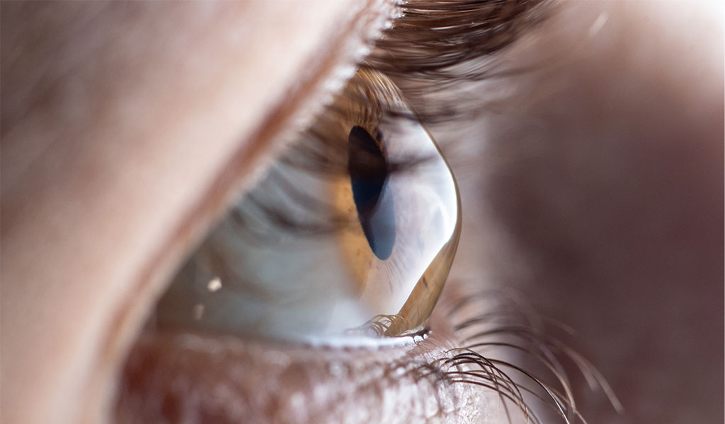 astigmatism in an eye