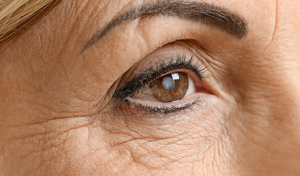 woman with cataract in eye