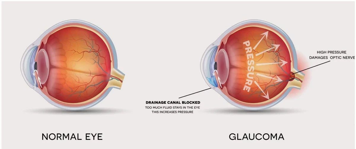 Glaucoma damages your optic nerve