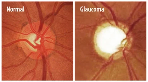 Glaucoma in your eyes